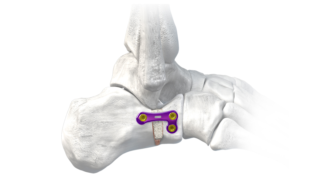 Gorilla® Universal HEvans® Plate