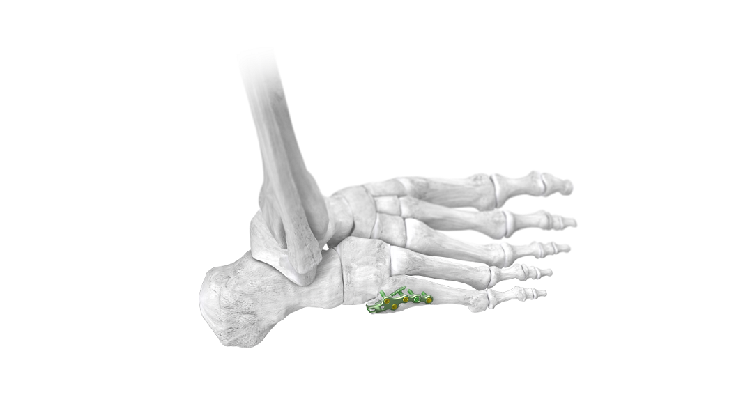 Baby Gorilla 5th Met/Jones Fracture Compression Plates
