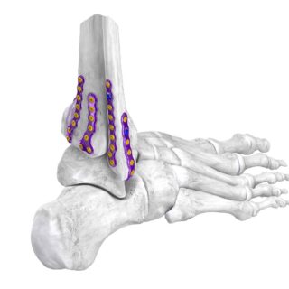 gorilla ankle fracture