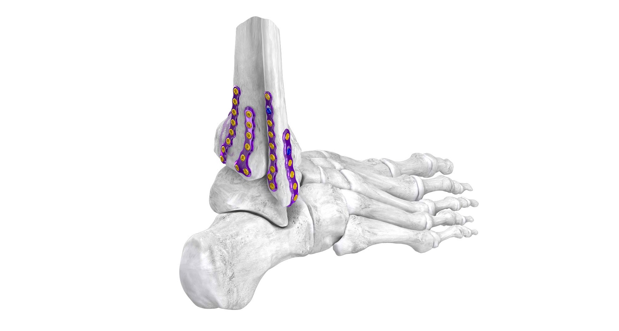 gorilla ankle fracture