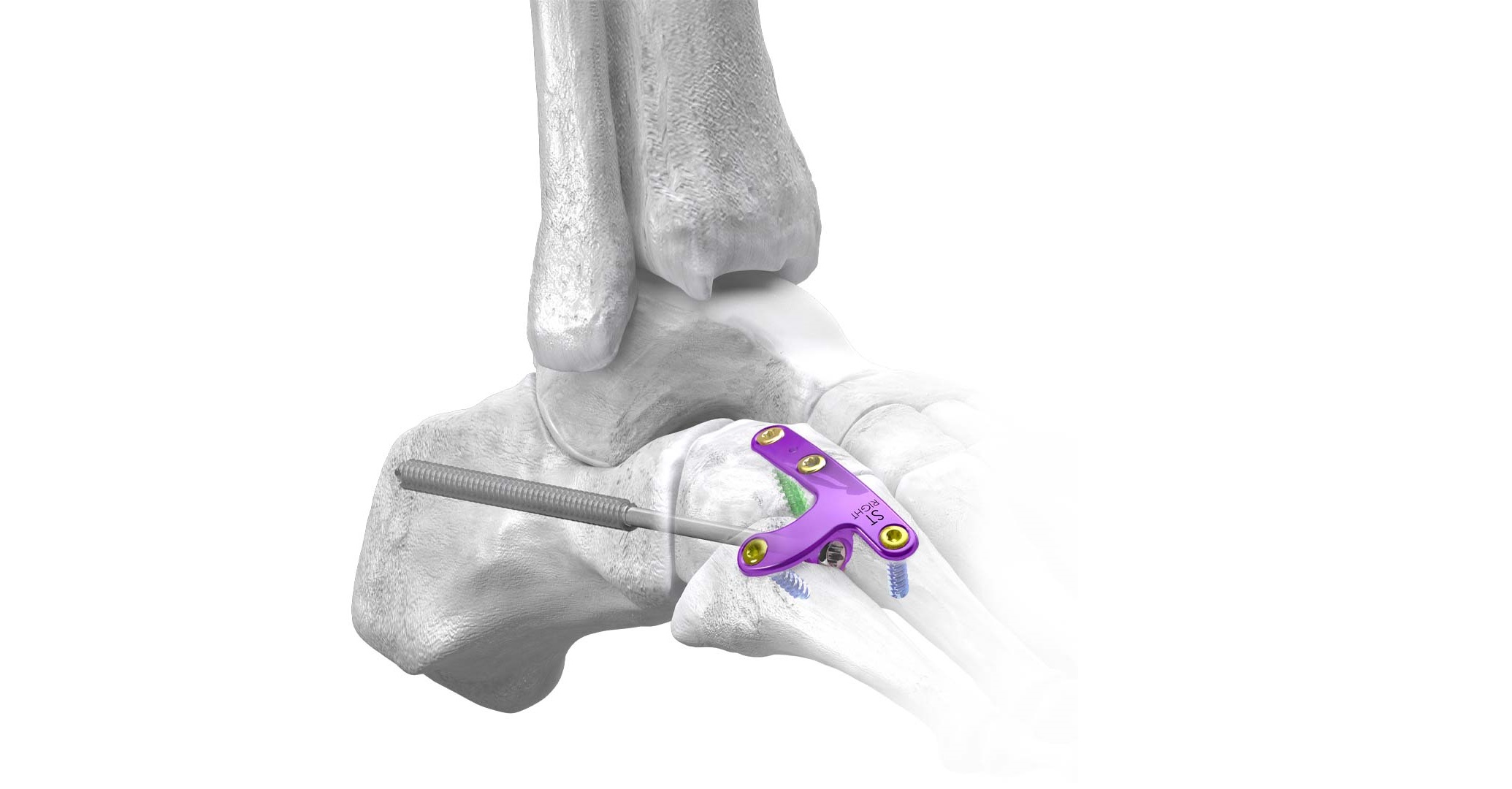gorilla lateral column