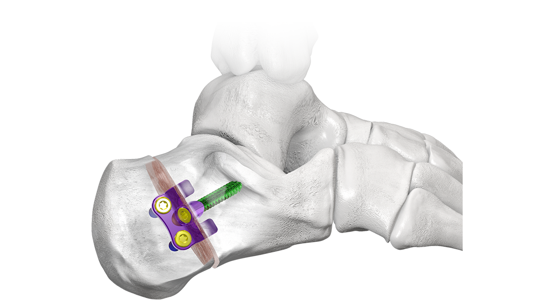 gorilla universal cal clide