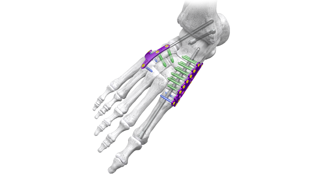 gorilla medial column