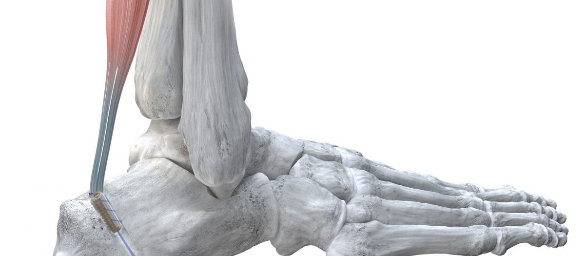 Grappler Interference Screw System