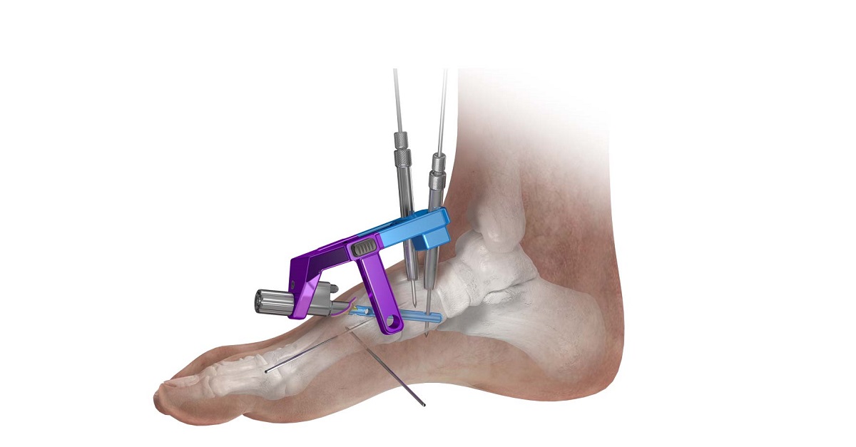 Phantom® MIS System
