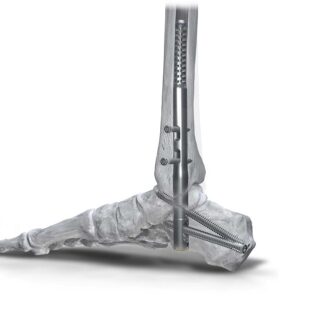 Phantom Hindfoot TTC/TC System