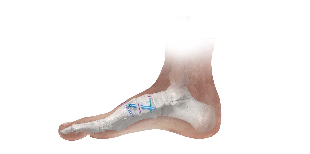 Phantom Intramedullary Nail