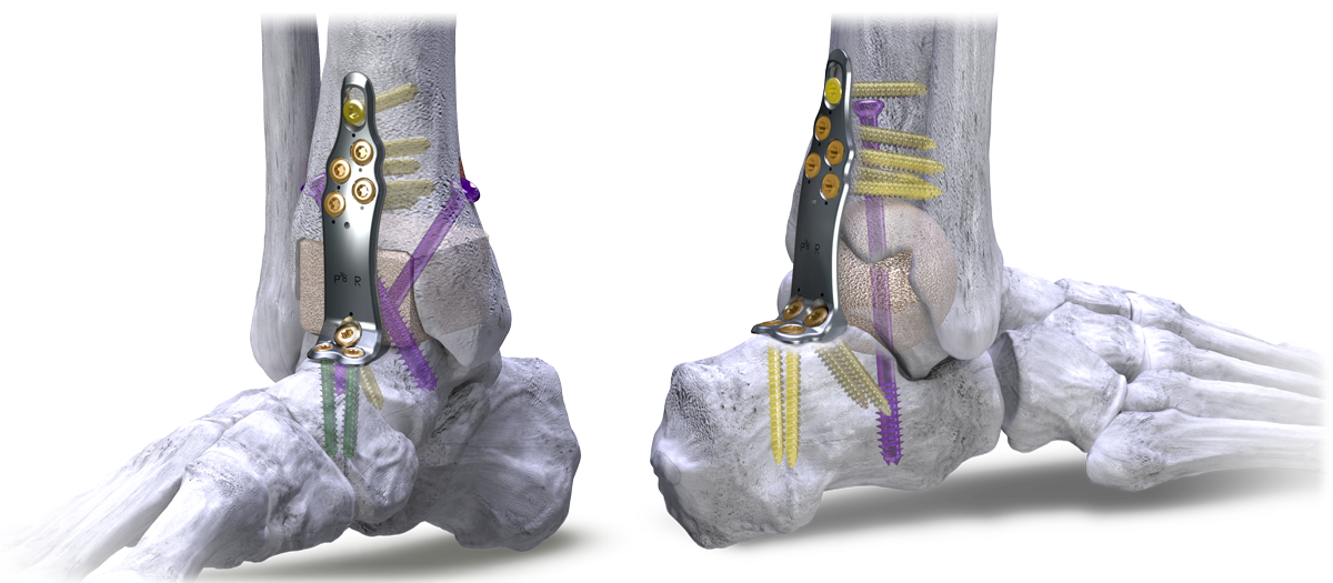 silverback span plate