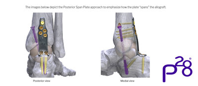 Silverback™ Span Plating System – Posterior Span Plates