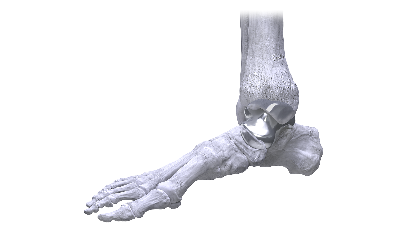 total talus replacement