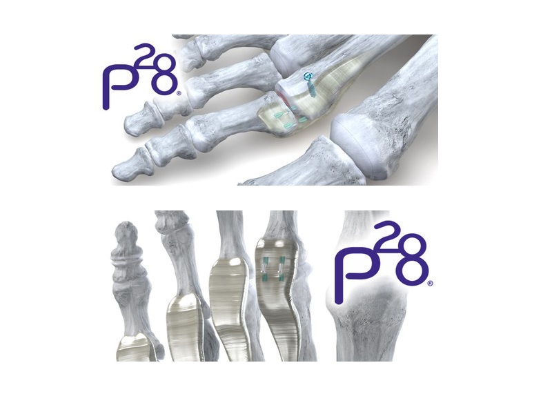 Launch of Paratrooper™ Plantar Plate System