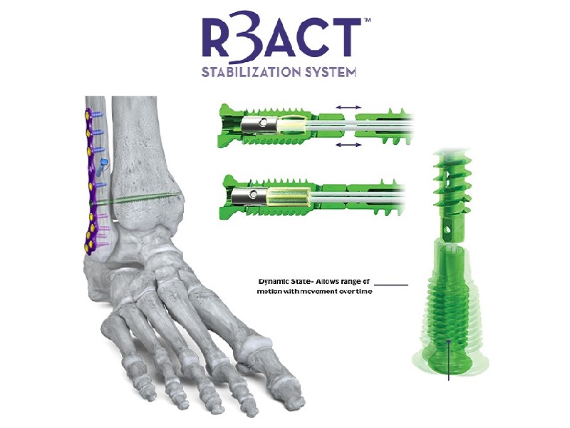 Paragon 28 Launches R3ACT™ Stabilization System