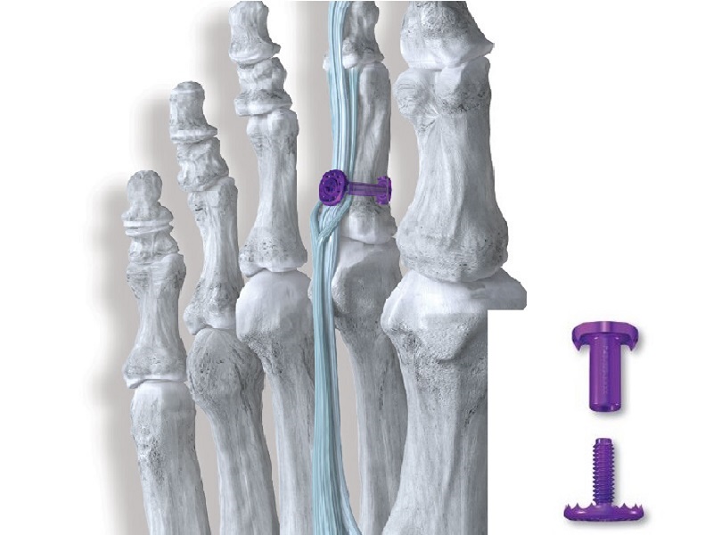 Launch of TenoTac™ 2.0 Soft Tissue Stabilization System