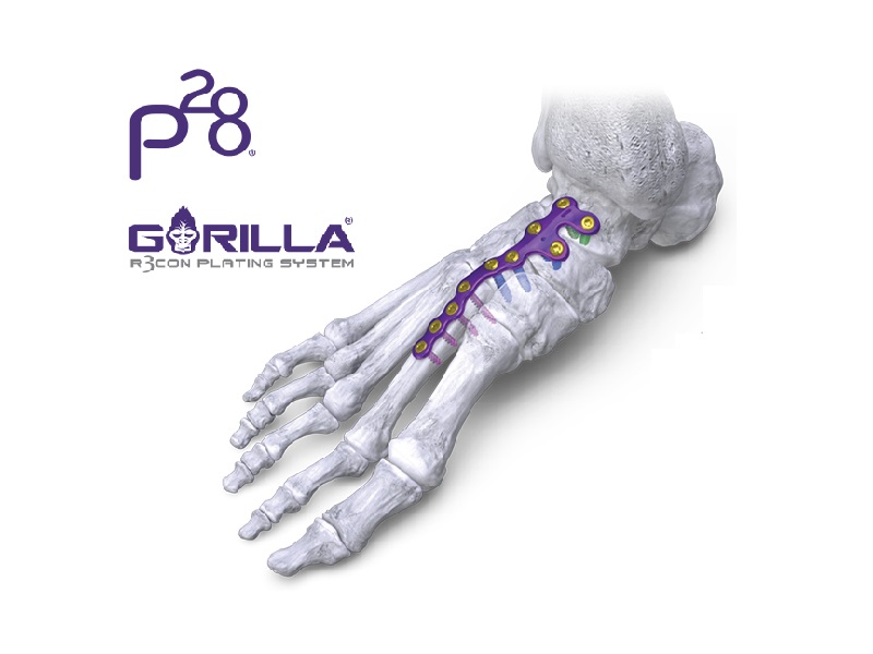 Launch of Gorilla® Central Column Plating System