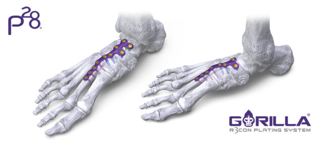 Central Column Plating System