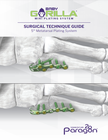 5th metatarsal baby gorilla