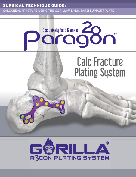 calc fracture plating system