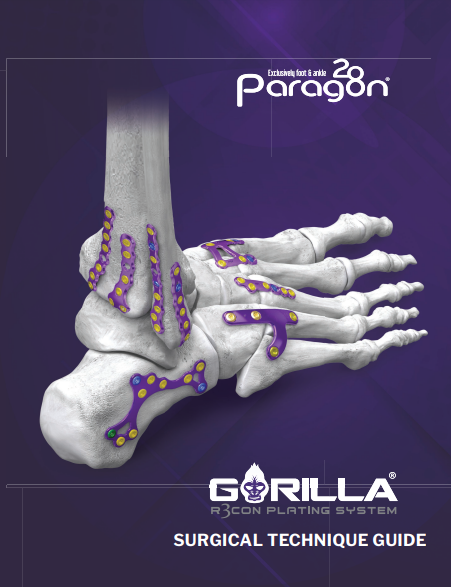 gorilla plating system
