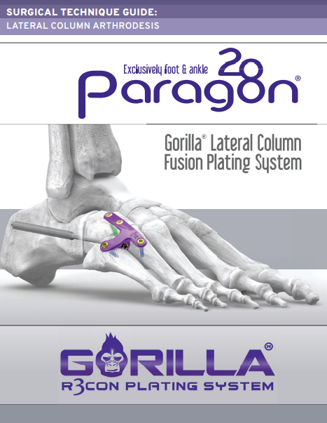 lateral column fusion