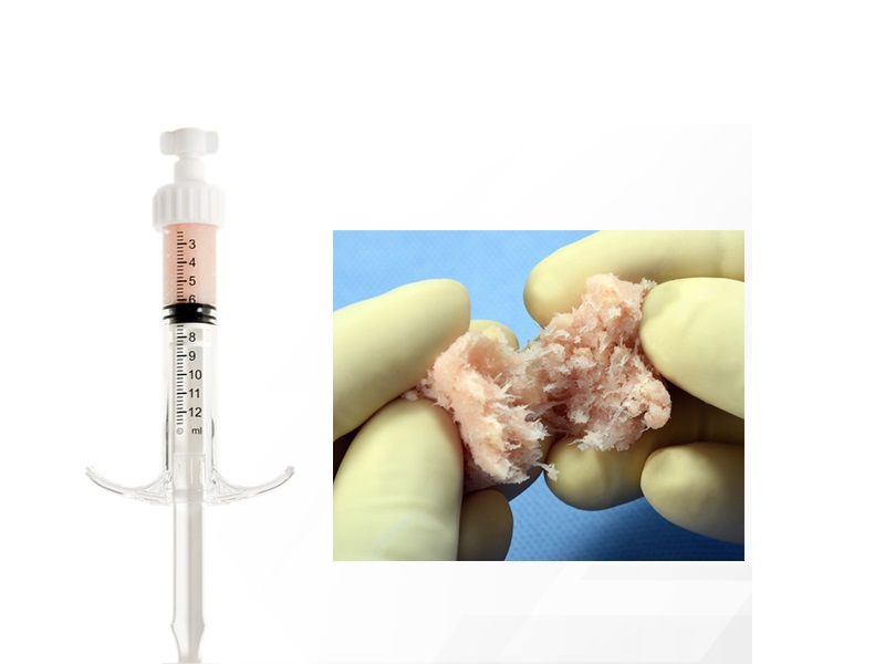 Launch of V92™-FC+ Bone Matrix