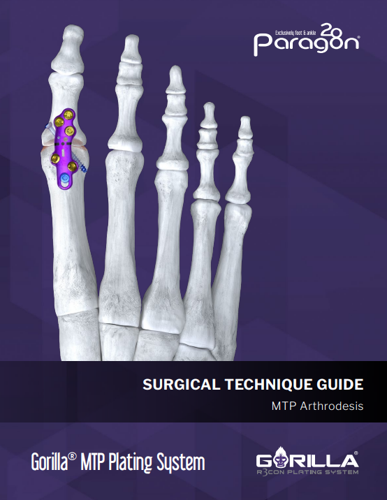 gorilla mtp plating systen