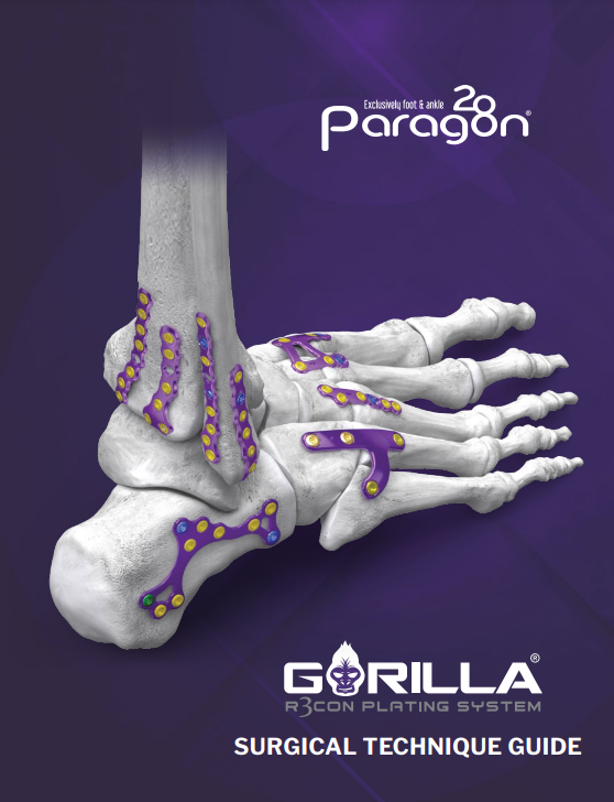 gorilla recon plating system