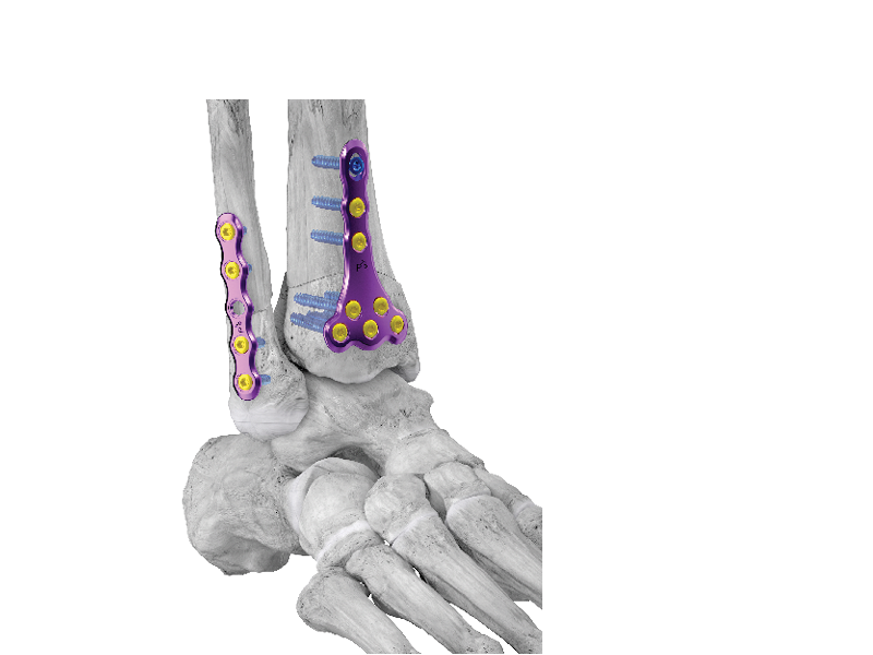 Launch of Supramalleolar Osteotomy System