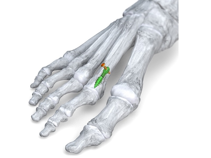 Launch of Phantom® Metatarsal Shortening System