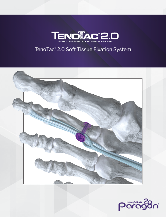 tenotac