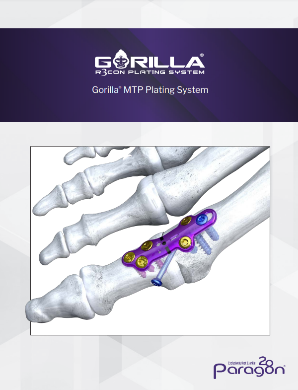 gorilla mtp plating system