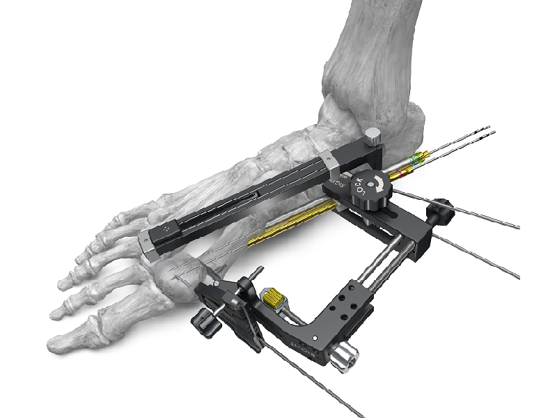 Launch of PRECISION® MIS Bunion System