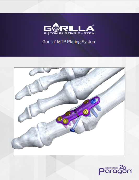 gorilla mtp plating
