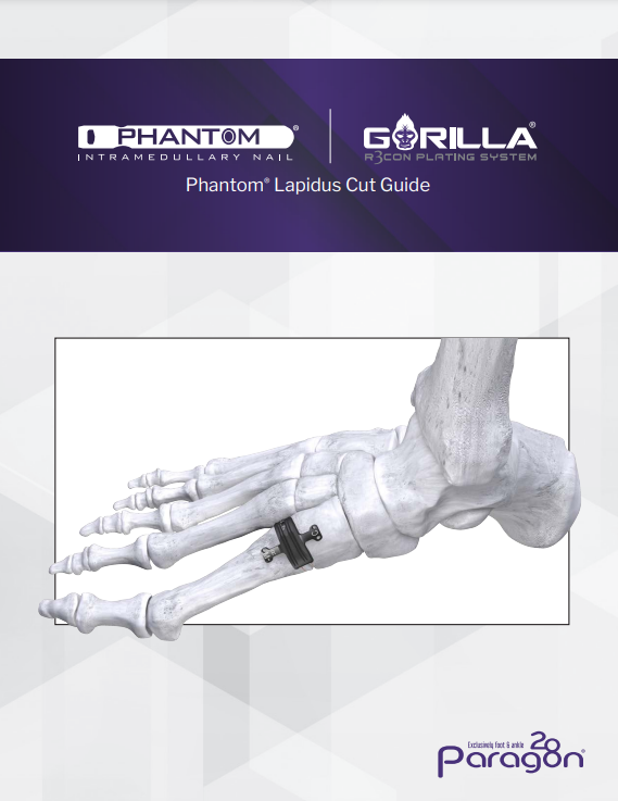 phantom lapidus guide