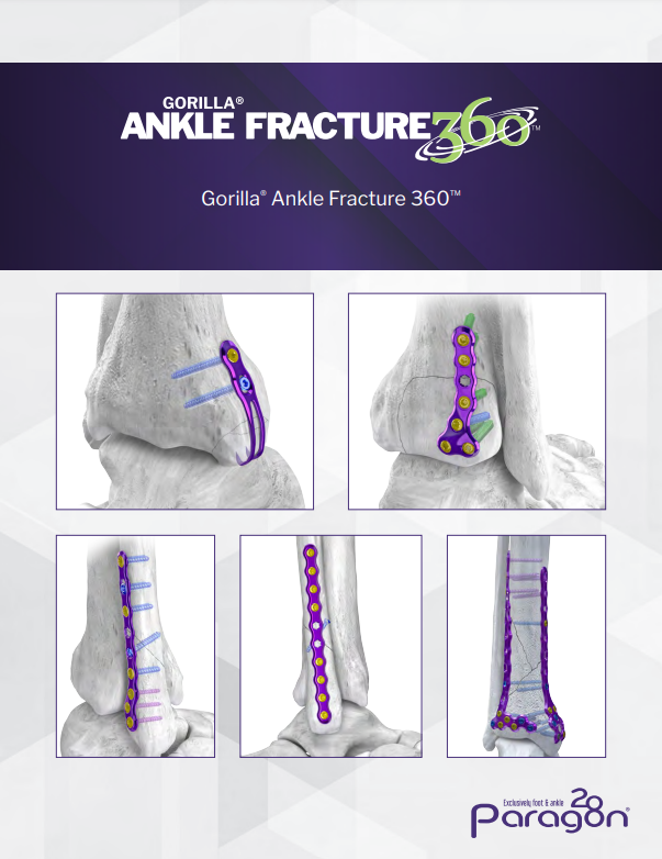 gorilla ankle fracture