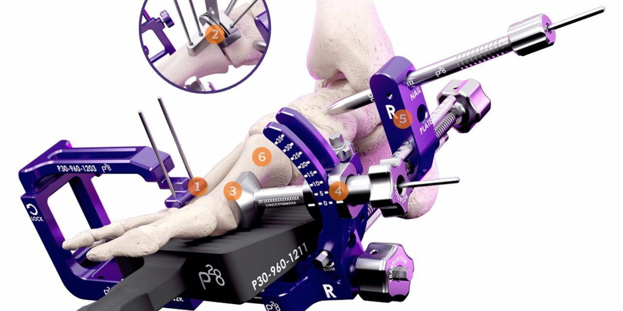 Paragon 28 Announces the Launch of SMART 28℠ Portal and First Case Using SMART Bun-Yo-Matic℠