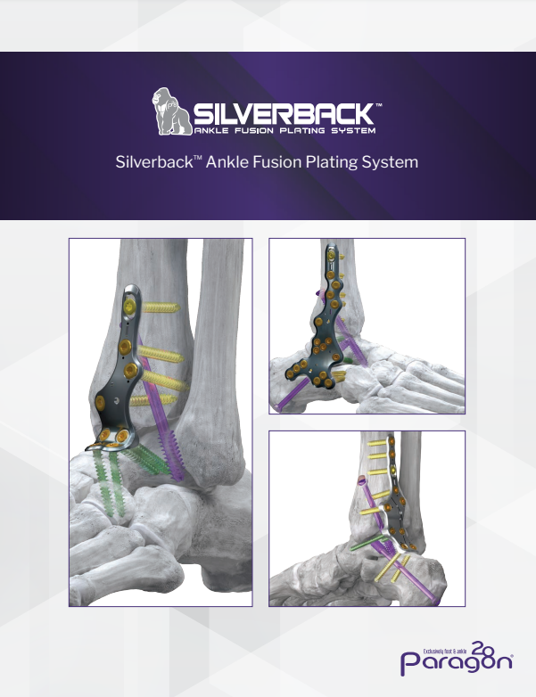 silverback ankle fusion brochure