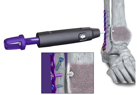 Paragon 28 Launches the R3FLEX™ Stabilization System to Anatomically Repair Ankle Syndesmotic Injuries