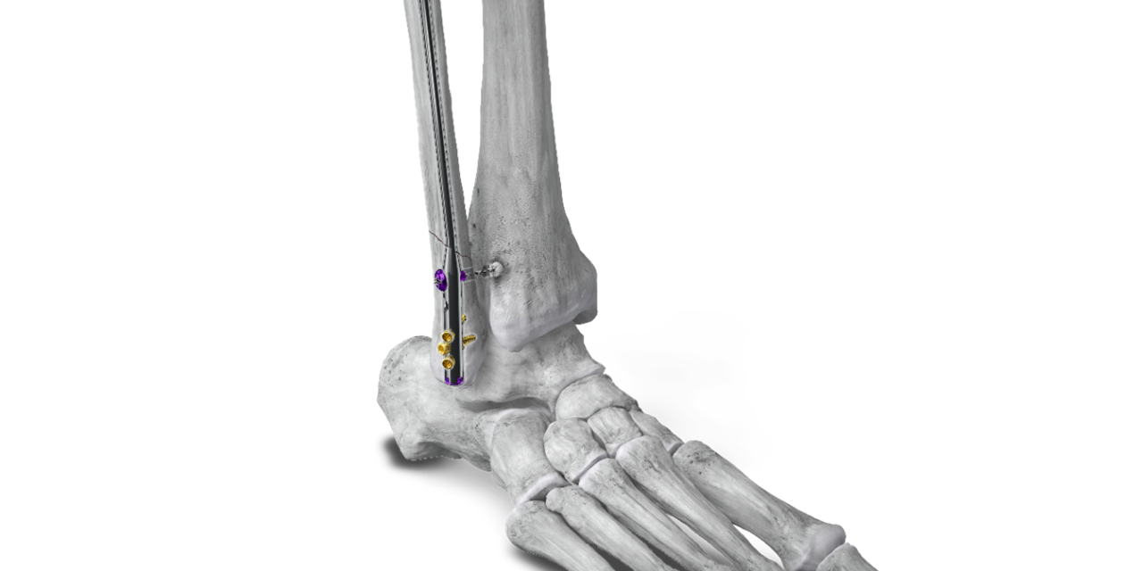 Paragon 28 Launches the Phantom® Fibula Nail System for Less Invasive Fracture Repair