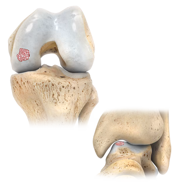 https://paragon.fru.qa/app/uploads/2025/06/ocaosteochondral.avif