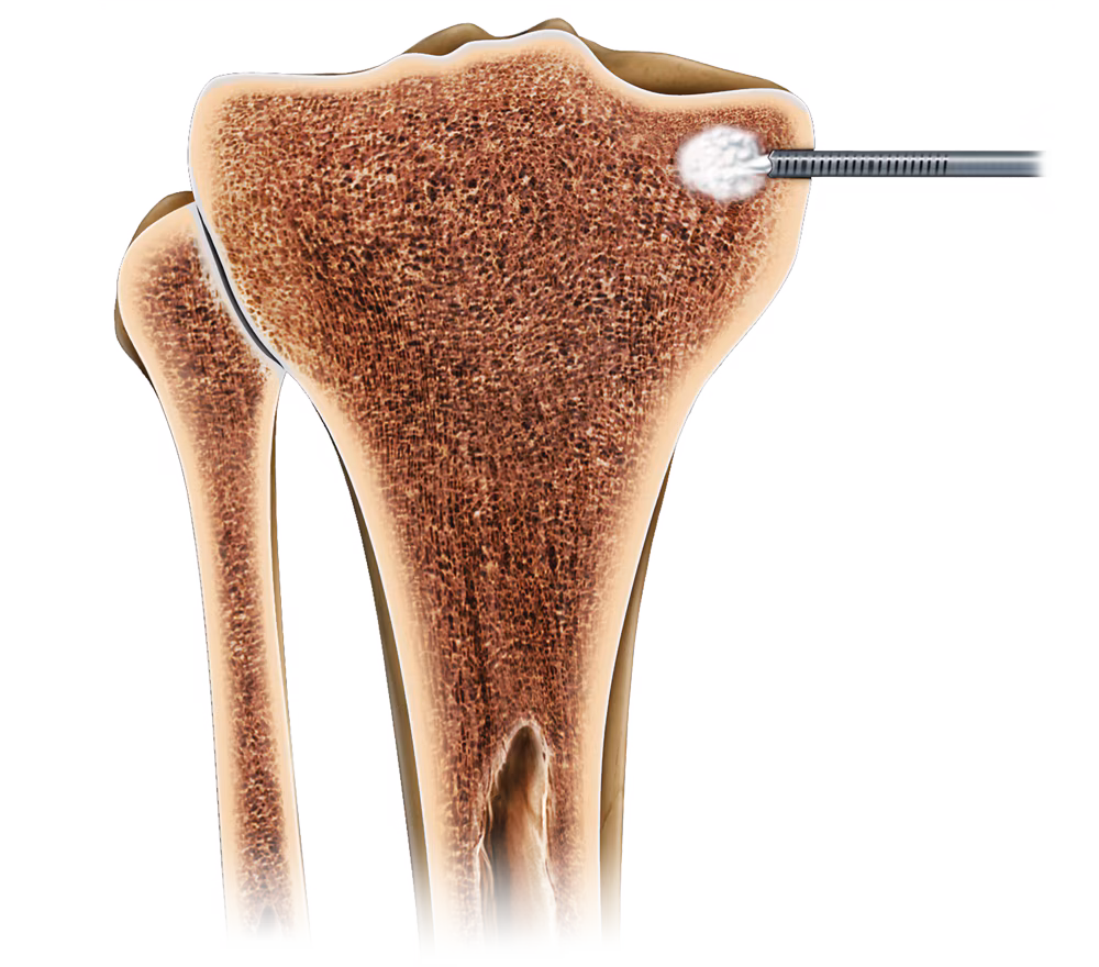 https://paragon.fru.qa/app/uploads/2025/06/subchondroplasty1imagecomponent.avif