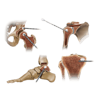 https://paragon.fru.qa/app/uploads/2025/07/Subchondroplasty-320x320.png