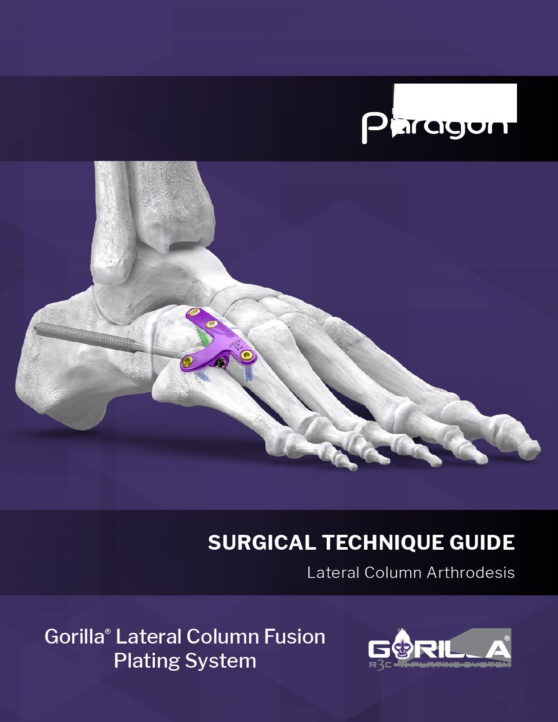 https://paragon.fru.qa/app/uploads/2025/08/P51-STG-0010_RevF_Gorilla-Lateral-Column-Fusion-STGUS-pdf.jpg