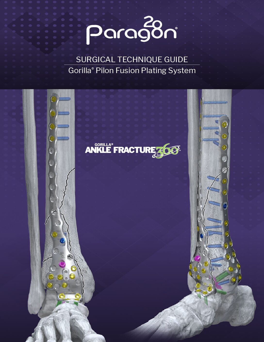 https://paragon.fru.qa/app/uploads/2025/08/P51-STG-0015-PilonFusion_STG_RevA-US-DIGITAL-pdf.jpg