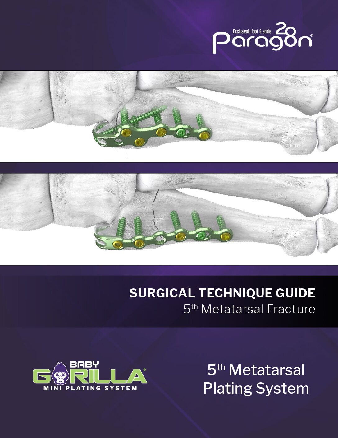 https://paragon.fru.qa/app/uploads/2025/08/P53-STG-0002-Rev-E-Baby-Gorilla-5th-Metatarsal-Fracture-STG-US-pdf.jpg