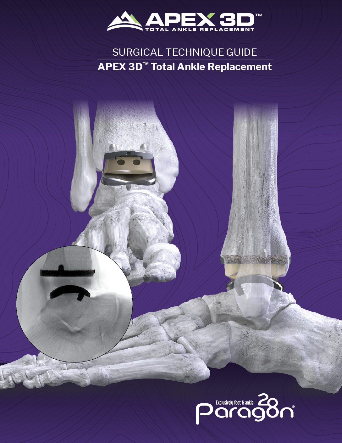 https://paragon.fru.qa/app/uploads/2025/09/P10-STG-0001-RevK_APEX-Total-Ankle-Replacement-System-US-pdf.jpg