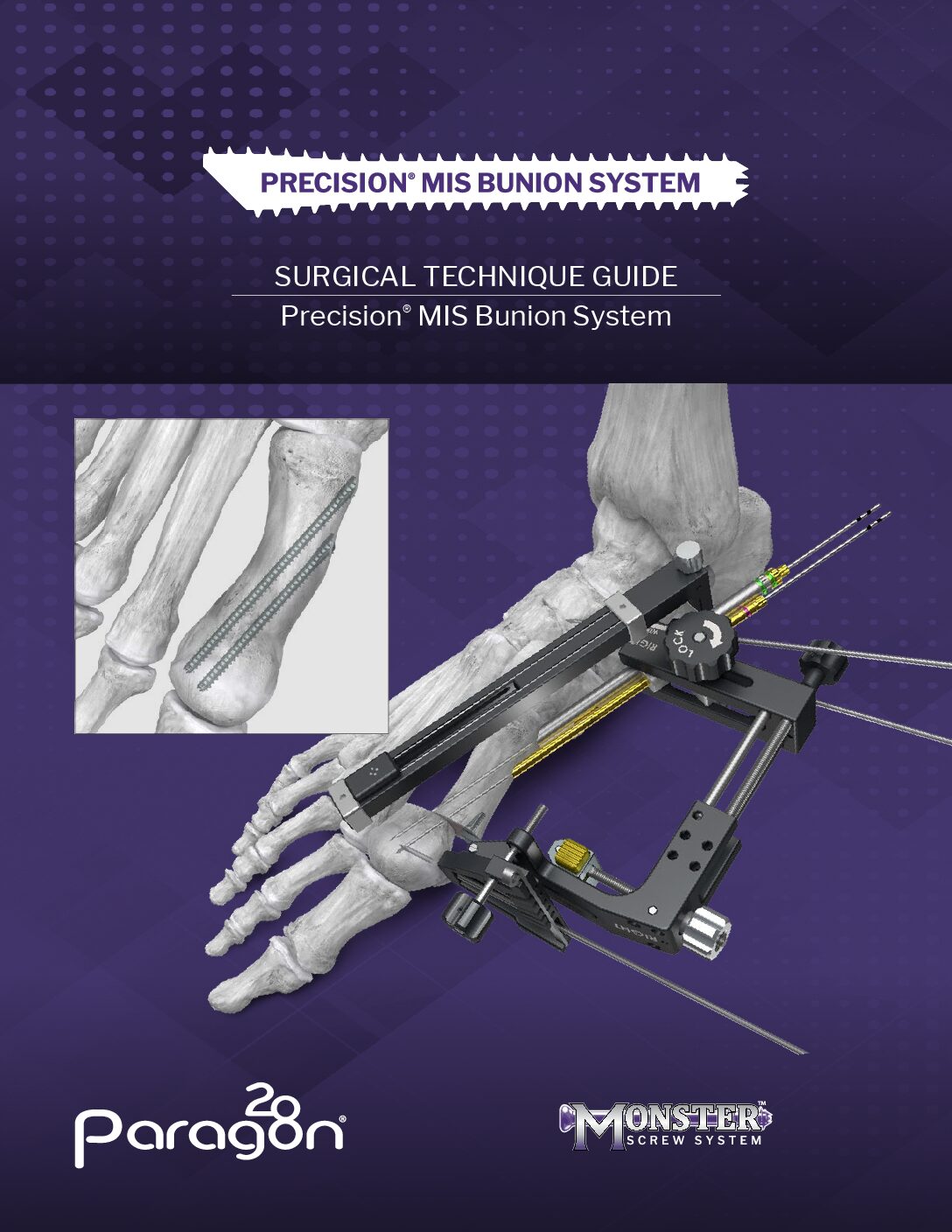 https://paragon.fru.qa/app/uploads/2025/09/P27-STG-2001-Rev-A_Precision_MIS_Bunion_System_STG-CAN-pdf.jpg