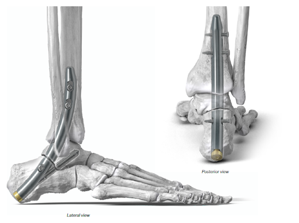 https://paragon.fru.qa/app/uploads/2025/11/Phantom-Curved-Hindfoot-Fusion-Nail.png
