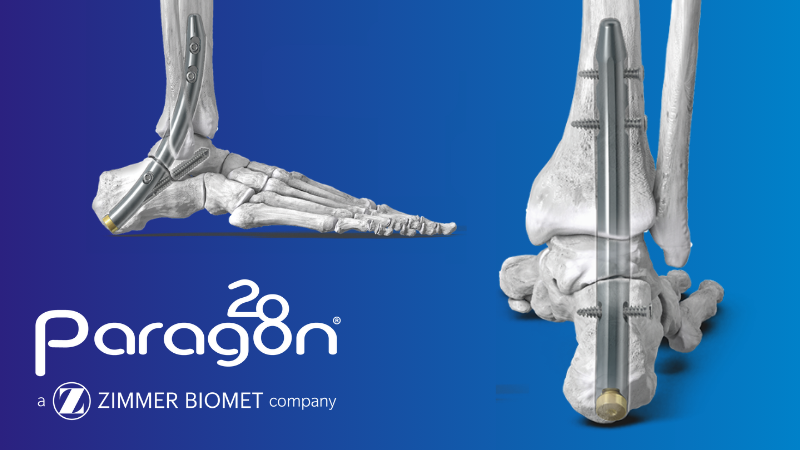 Zimmer Biomet Launches Advancement for Hindfoot Fusion