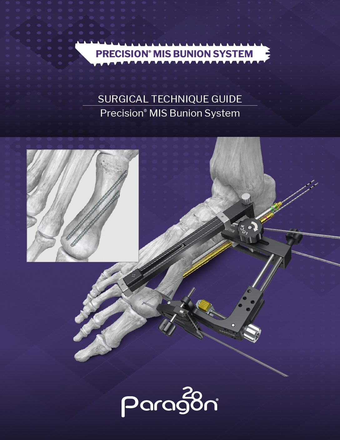 https://paragon.fru.qa/app/uploads/2026/02/STG-Precision-MIS-Bunion-System-Rev-D-pdf.jpg